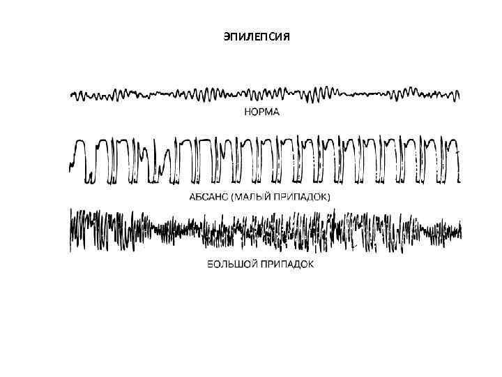 ЭПИЛЕПСИЯ 