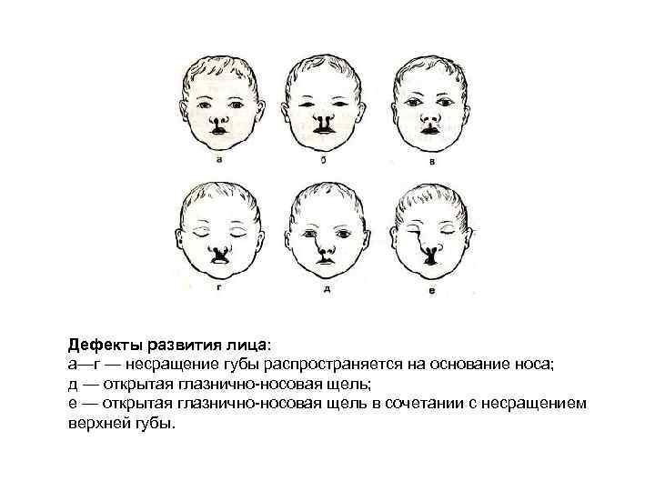 Дефекты развития лица: а—г — несращение губы распространяется на основание носа; д — открытая