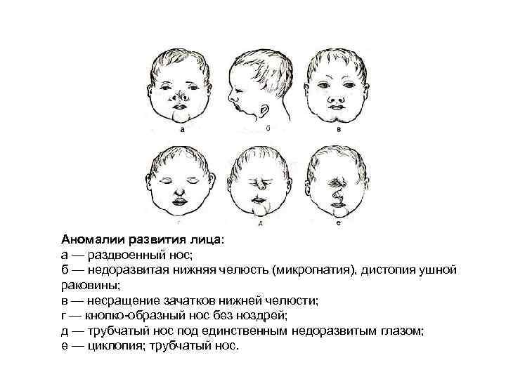 Развитие лицевой области. Врожденные пороки развития лица. Пороки развития ушной раковины. Анамалии развитие носа.