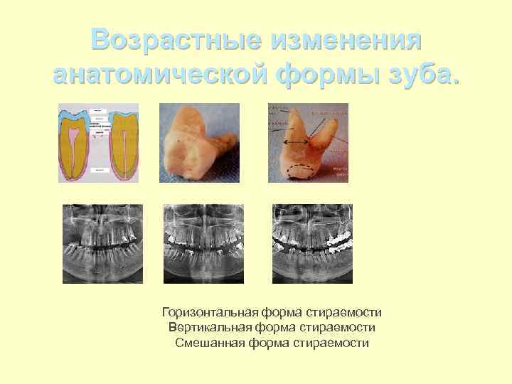 Горизонтальная форма. Классификация Грозовского стираемость зубов. Вертикальная и горизонтальная стираемость зубов. Локализованная и генерализованная патологическая стираемость. Горизонтальная патологическая стираемость.