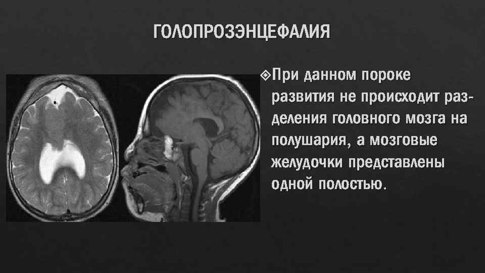 ГОЛОПРОЗЭНЦЕФАЛИЯ При данном пороке развития не происходит разделения головного мозга на полушария, а мозговые