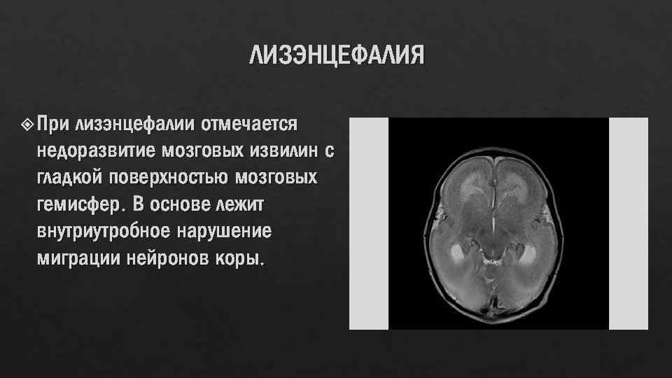 ЛИЗЭНЦЕФАЛИЯ При лизэнцефалии отмечается недоразвитие мозговых извилин с гладкой поверхностью мозговых гемисфер. В основе