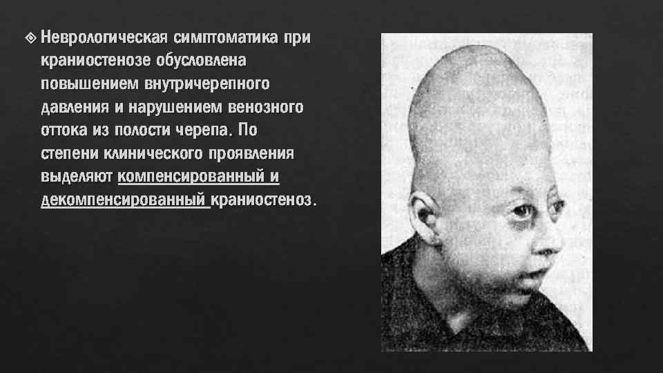  Неврологическая симптоматика при краниостенозе обусловлена повышением внутричерепного давления и нарушением венозного оттока из