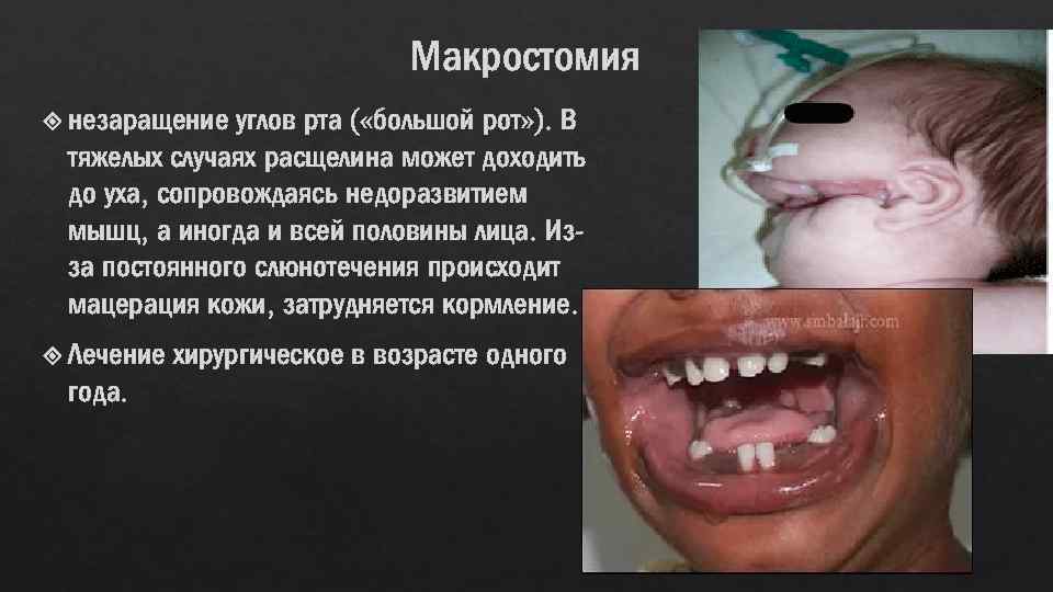 Макростомия углов рта ( «большой рот» ). В тяжелых случаях расщелина может доходить до