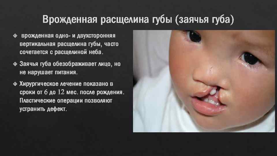 Врожденная расщелина губы (заячья губа) врожденная одно- и двухсторонняя вертикальная расщелина губы, часто сочетается