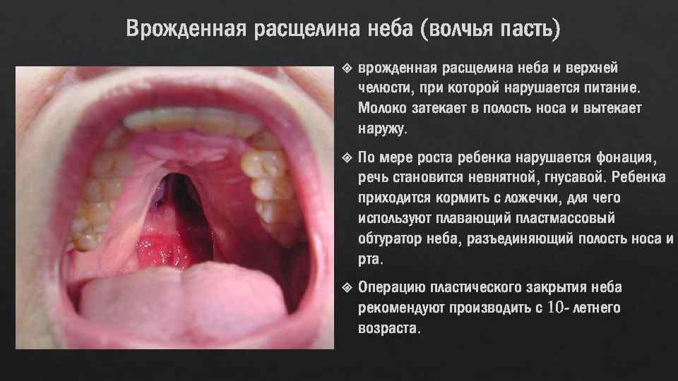 Врожденная расщелина неба (волчья пасть) врожденная расщелина неба и верхней челюсти, при которой нарушается