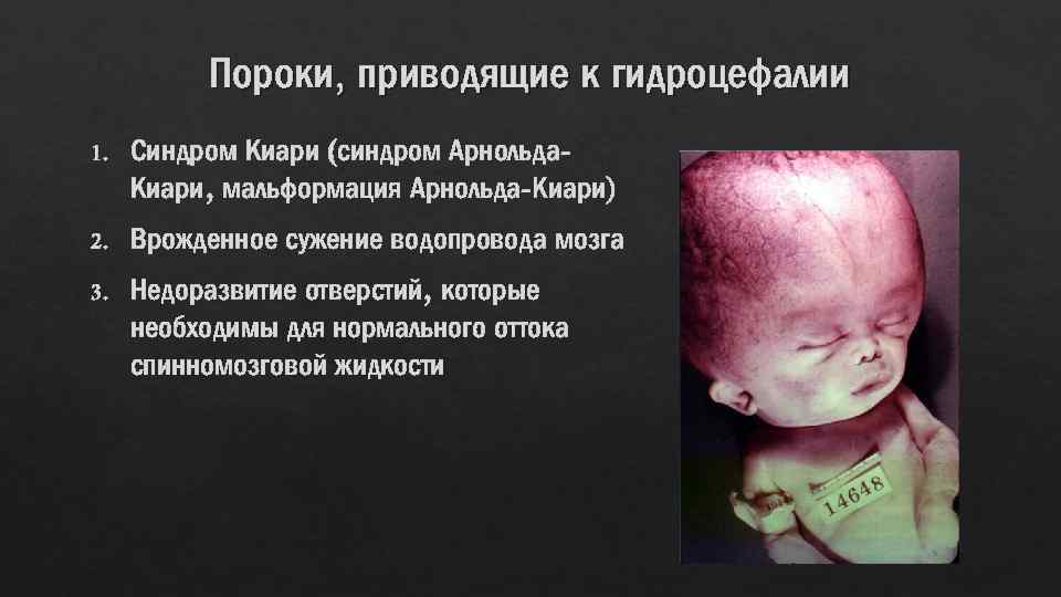 Пороки, приводящие к гидроцефалии 1. Синдром Киари (синдром Арнольда. Киари, мальформация Арнольда-Киари) 2. Врожденное