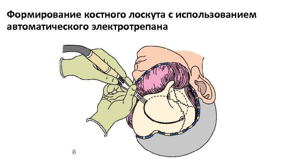 Трепанация треугольника шипо