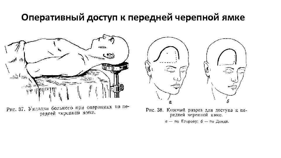 Оперативный доступ к передней черепной ямке 