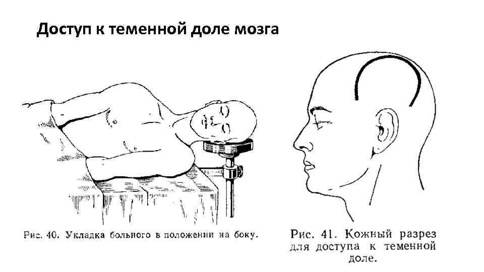 Доступ к теменной доле мозга 