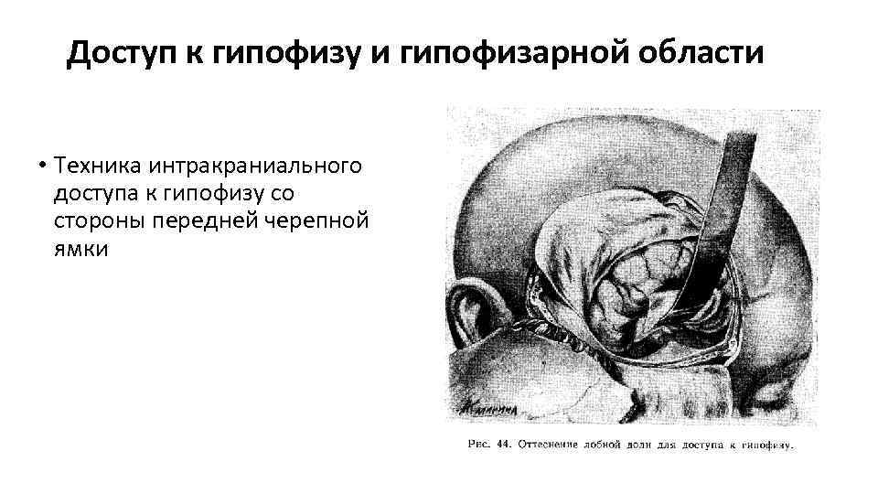 Доступ к гипофизу и гипофизарной области • Техника интракраниального доступа к гипофизу со стороны