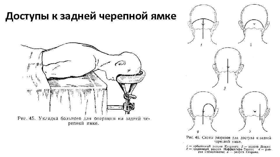 Доступы к задней черепной ямке 