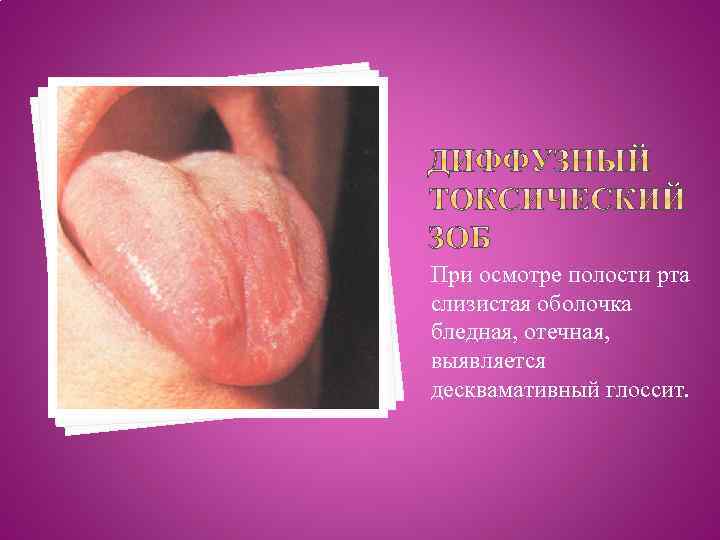 При осмотре полости рта слизистая оболочка бледная, отечная, выявляется десквамативный глоссит. 