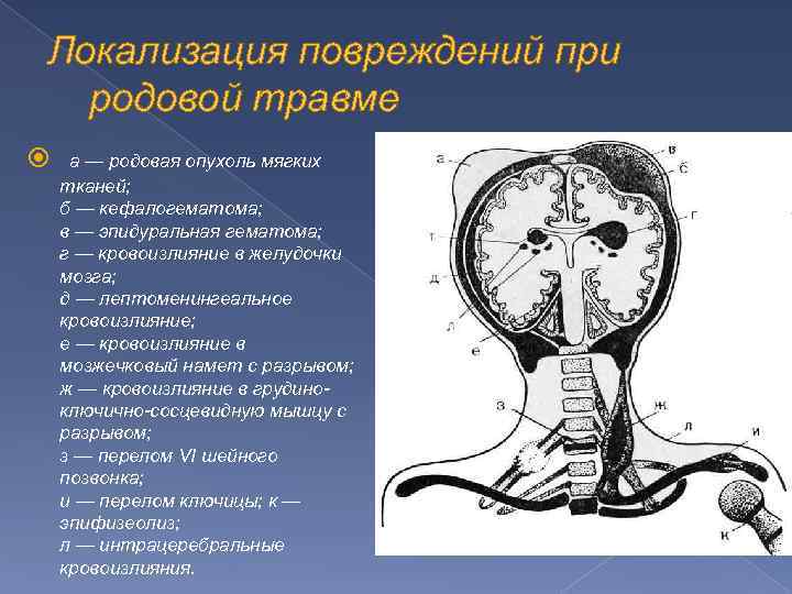 Локализация повреждений при родовой травме а — родовая опухоль мягких тканей; б — кефалогематома;