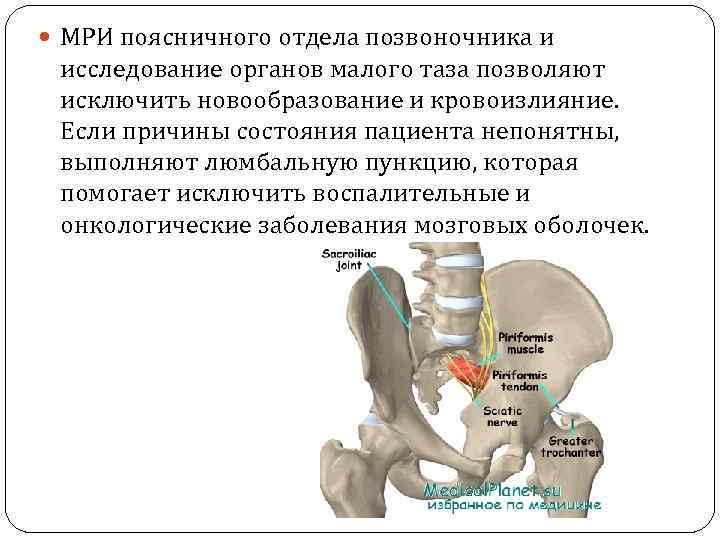  МРИ поясничного отдела позвоночника и исследование органов малого таза позволяют исключить новообразование и