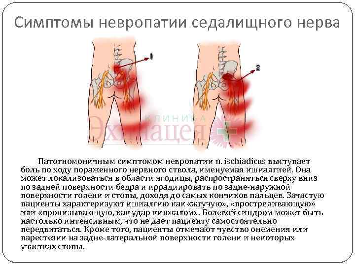 Симптомы невропатии седалищного нерва Патогномоничным симптомом невропатии n. ischiadicus выступает боль по ходу пораженного