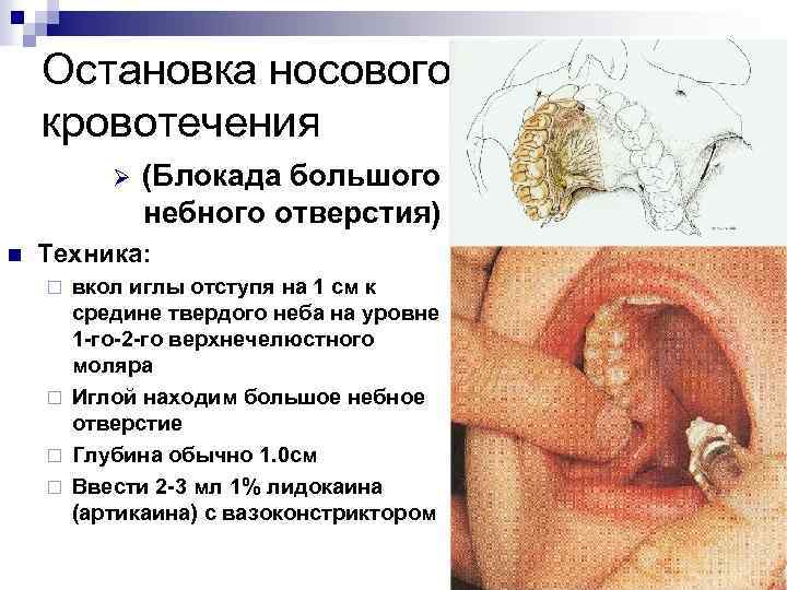 Остановка носового кровотечения Ø n (Блокада большого небного отверстия) Техника: вкол иглы отступя на