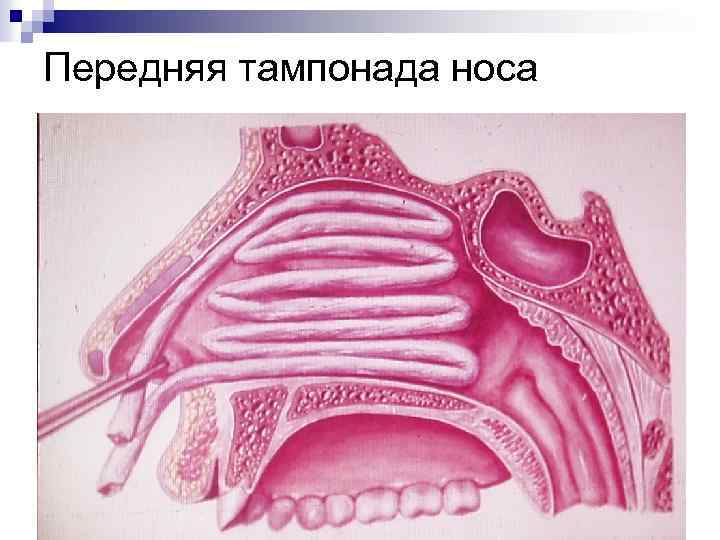 Передняя тампонада носа 