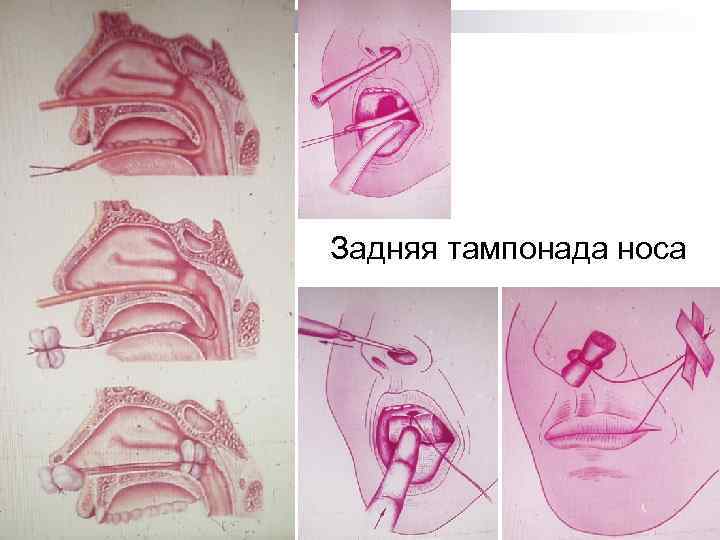 Задняя тампонада носа 