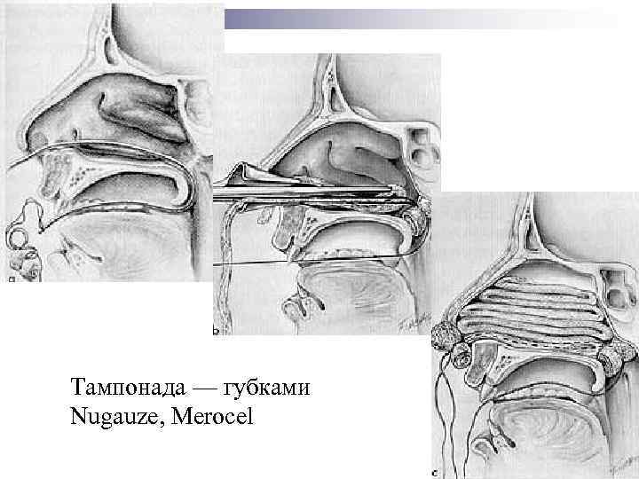 Тампонада. Тампонада ЛОР тампонада носа. Тампонада носа гемостатической губкой. Тампонада носа алгоритм.