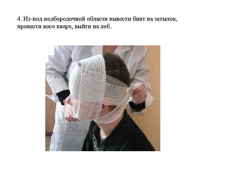4. Из-под подбородочной области вывести бинт на затылок, провести косо вверх, выйти на лоб.