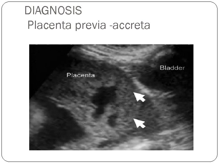 DIAGNOSIS Placenta previa -accreta 