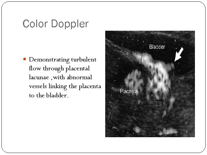 Color Doppler Demonstrating turbulent flow through placental lacunae , with abnormal vessels linking the