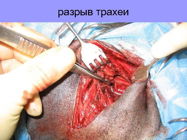 разрыв трахеи 
