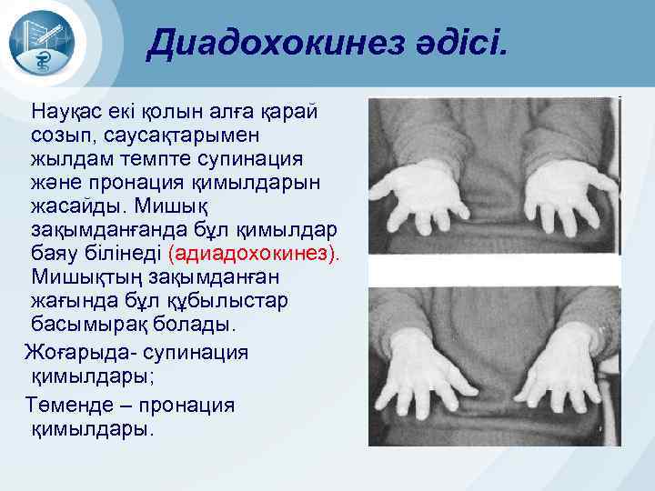 Диадохокинез әдісі. Науқас екі қолын алға қарай созып, саусақтарымен жылдам темпте супинация және пронация