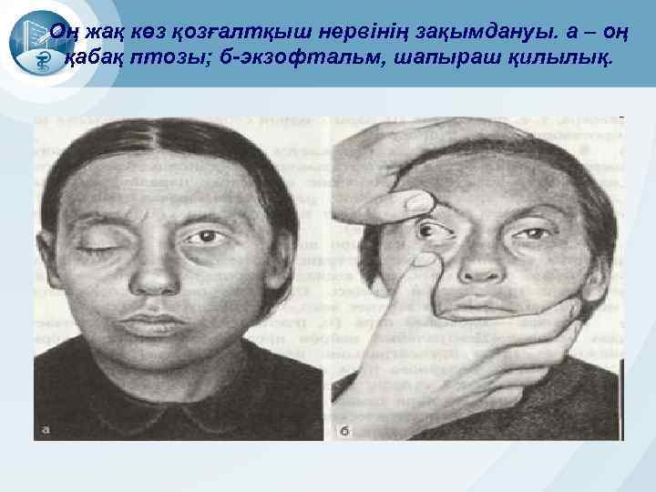 Оң жақ көз қозғалтқыш нервінің зақымдануы. а – оң қабақ птозы; б-экзофтальм, шапыраш қилылық.