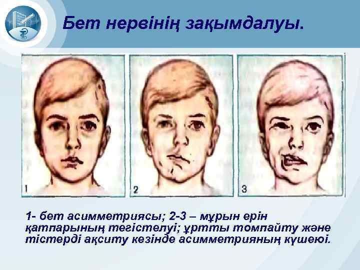 Бет нервінің зақымдалуы. 1 - бет асимметриясы; 2 -3 – мұрын ерін қатпарының тегістелуі;