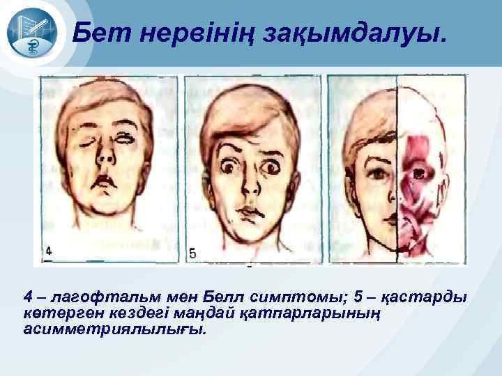 Бет нервінің зақымдалуы. 4 – лагофтальм мен Белл симптомы; 5 – қастарды көтерген кездегі