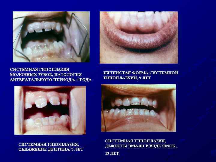 СИСТЕМНАЯ ГИПОПЛАЗИЯ МОЛОЧНЫХ ЗУБОВ, ПАТОЛОГИЯ АНТЕНАТАЛЬНОГО ПЕРИОДА, 4 ГОДА СИСТЕМНАЯ ГИПОПЛАЗИЯ, ОБНАЖЕНИЕ ДЕНТИНА, 7