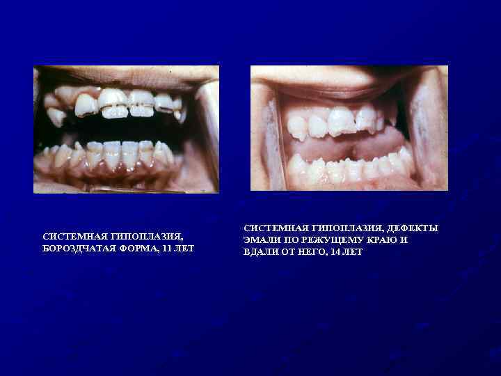 СИСТЕМНАЯ ГИПОПЛАЗИЯ, БОРОЗДЧАТАЯ ФОРМА, 11 ЛЕТ СИСТЕМНАЯ ГИПОПЛАЗИЯ, ДЕФЕКТЫ ЭМАЛИ ПО РЕЖУЩЕМУ КРАЮ И