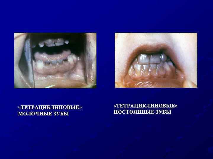  «ТЕТРАЦИКЛИНОВЫЕ» МОЛОЧНЫЕ ЗУБЫ «ТЕТРАЦИКЛИНОВЫЕ» ПОСТОЯННЫЕ ЗУБЫ 