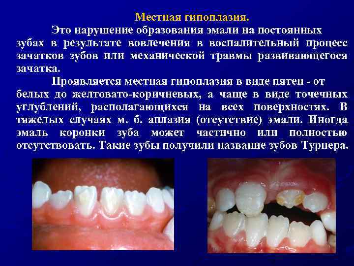 Местная гипоплазия. Это нарушение образования эмали на постоянных зубах в результате вовлечения в воспалительный