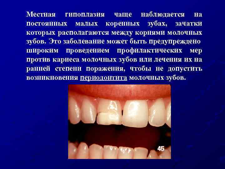 Местная гипоплазия чаще наблюдается на постоянных малых коренных зубах, зачатки которых располагаются между корнями