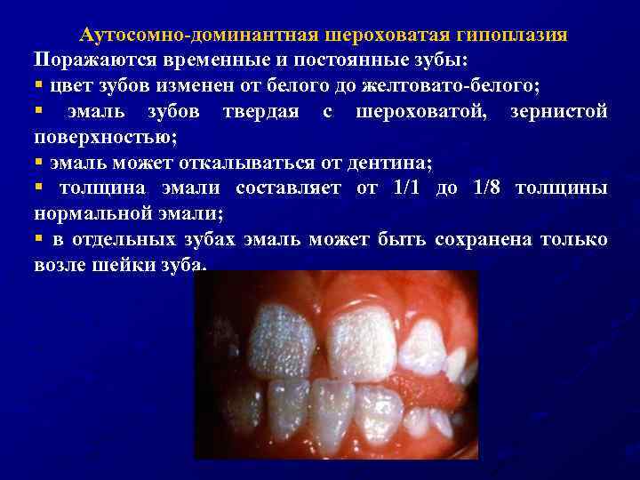 Аутосомно-доминантная шероховатая гипоплазия Поражаются временные и постоянные зубы: § цвет зубов изменен от белого