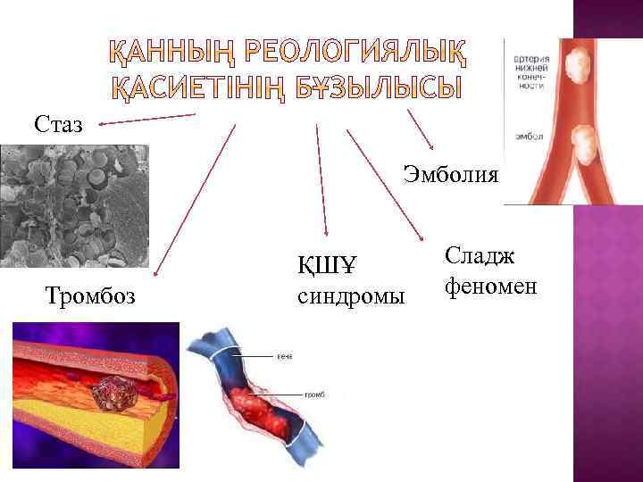 Стаз Эмболия Тромбоз ҚШҰ синдромы Сладж феномен 