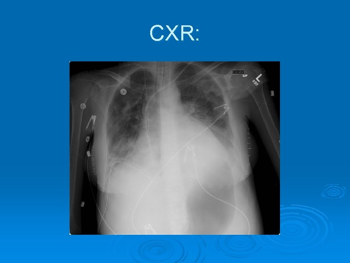 CXR: 