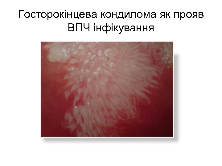 Госторокінцева кондилома як прояв ВПЧ інфікування 