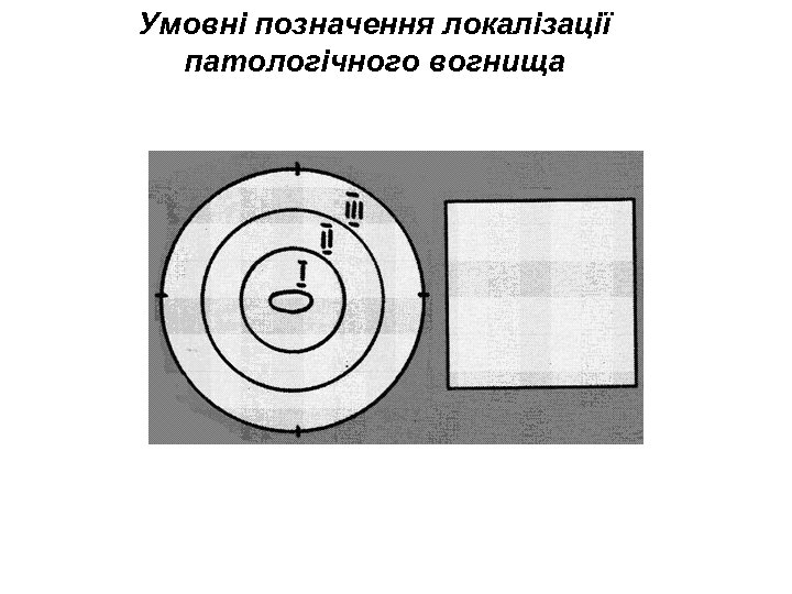 Умовні позначення локалізації патологічного вогнища 