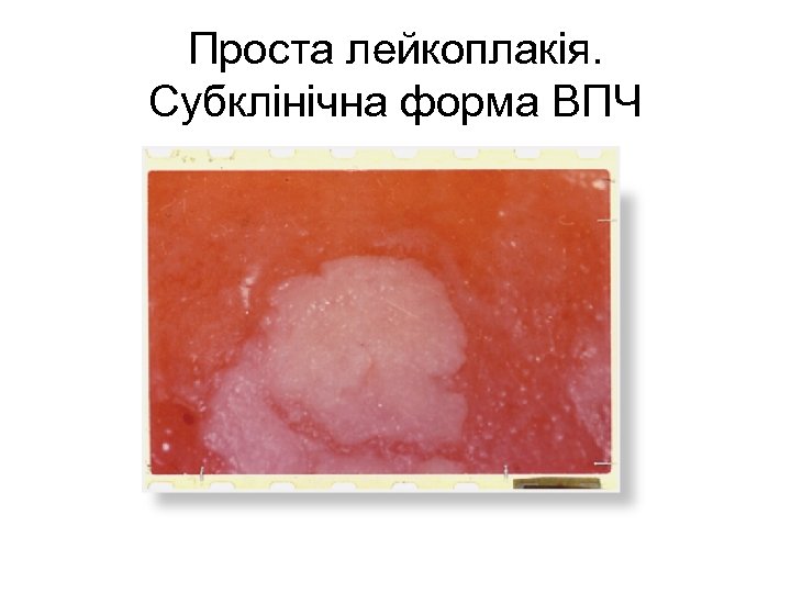 Проста лейкоплакія. Субклінічна форма ВПЧ 