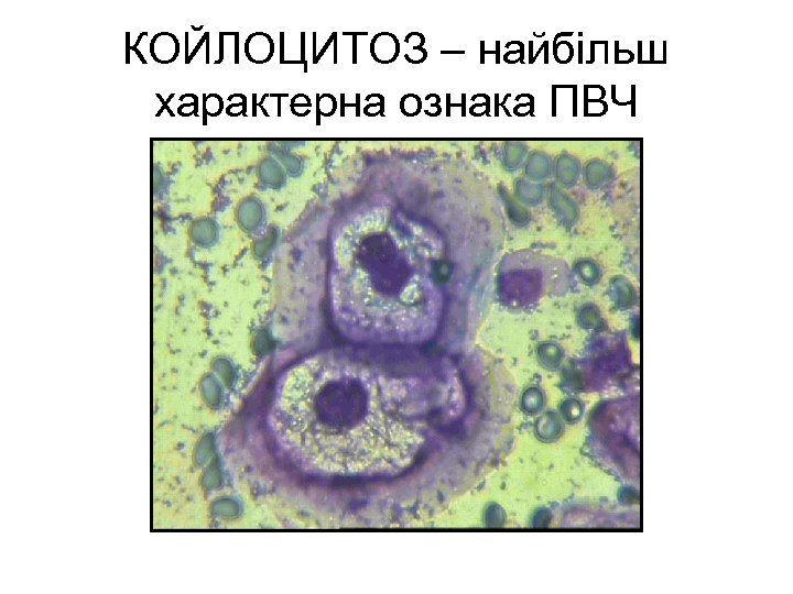 КОЙЛОЦИТОЗ – найбільш характерна ознака ПВЧ 