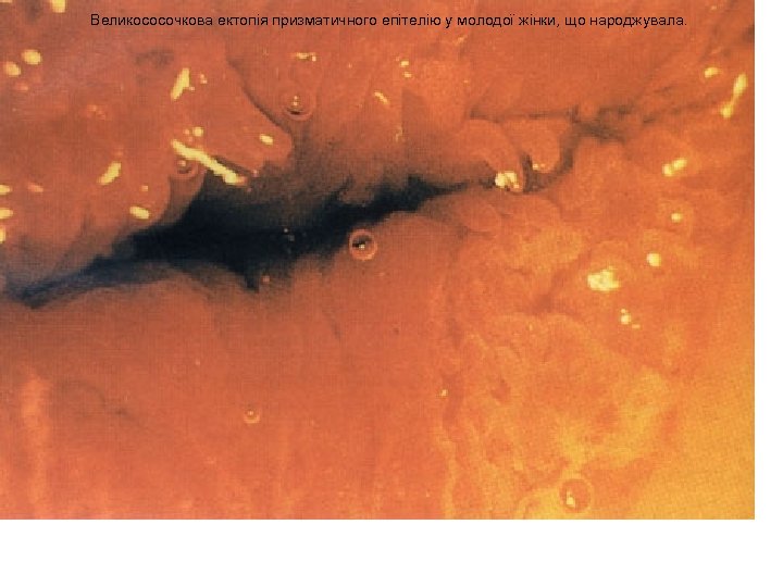 Великососочкова ектопія призматичного епітелію у молодої жінки, що народжувала. 