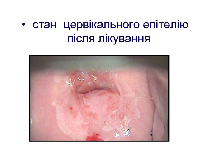  • стан цервікального епітелію після лікування 