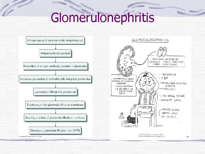 Glomerulonephritis 