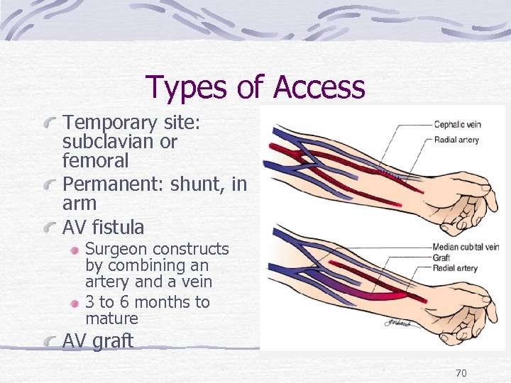 Types of Access Temporary site: subclavian or femoral Permanent: shunt, in arm AV fistula