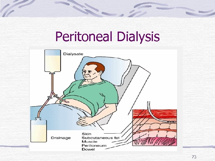 Peritoneal Dialysis 73 