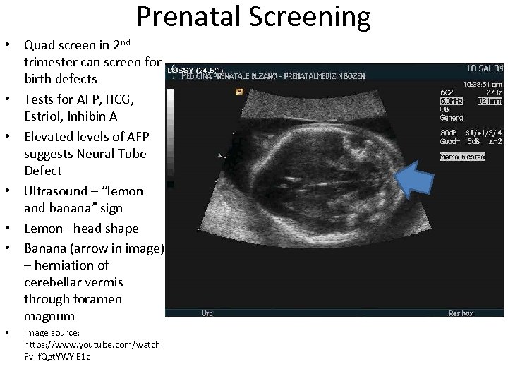 Prenatal Screening • Quad screen in 2 nd trimester can screen for birth defects